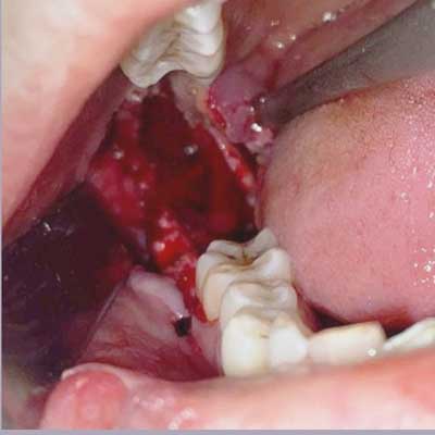 Odontogenic Cyst 2